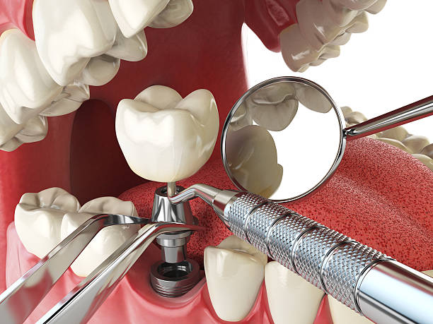 Best Emergency Root Canal Treatment in Pass Christian, MS